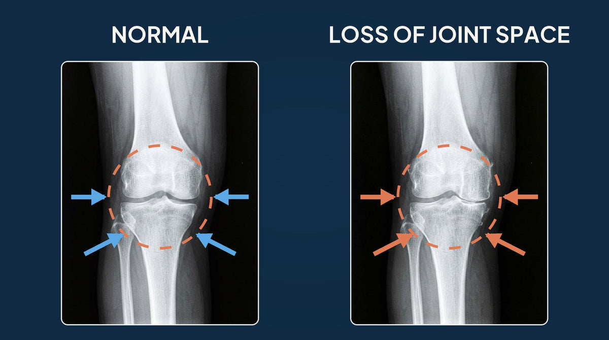 Knee X-ray: before and after replacement